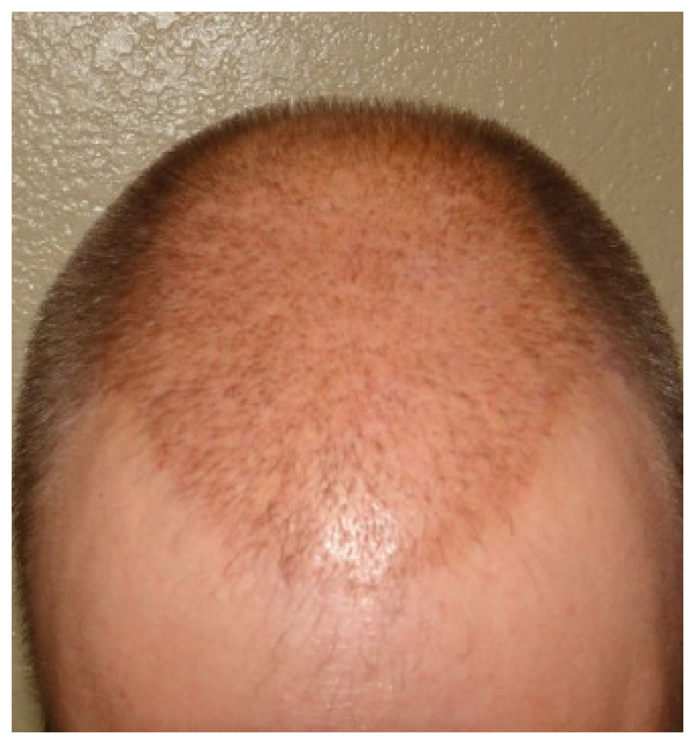 Patient 2- Ten days Post NeoGraft FUE hair transplant image