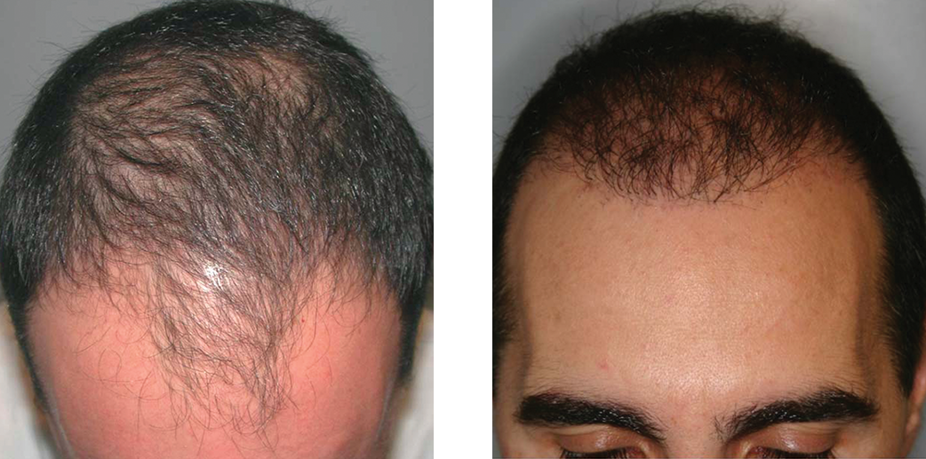 Hair transplant before and after image