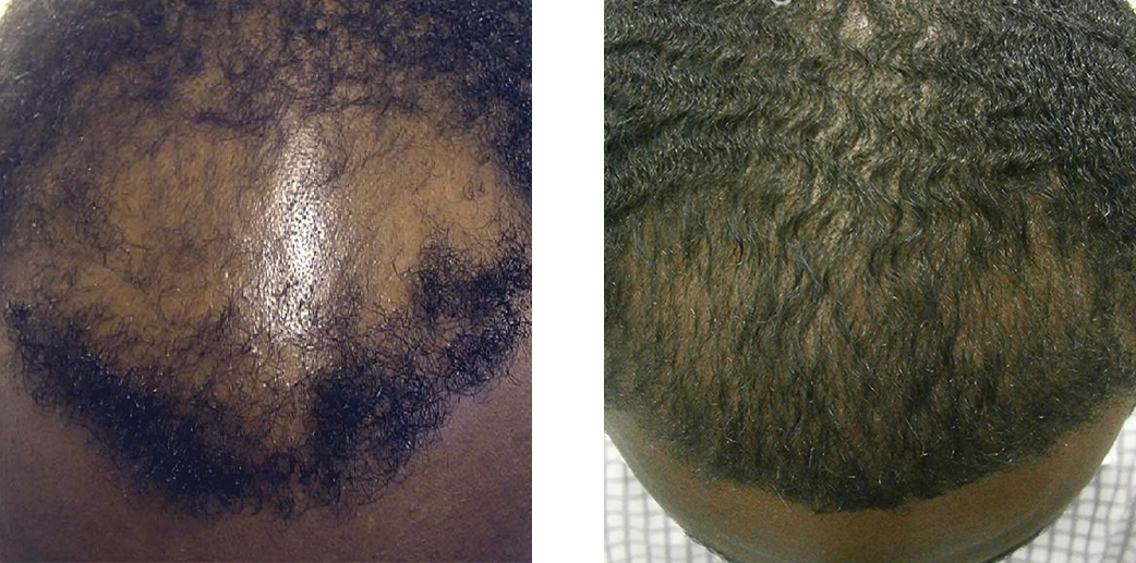 Hair transplant results before and after image 