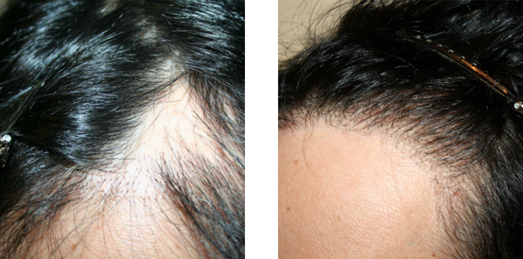 Woman before and after hair transplant image