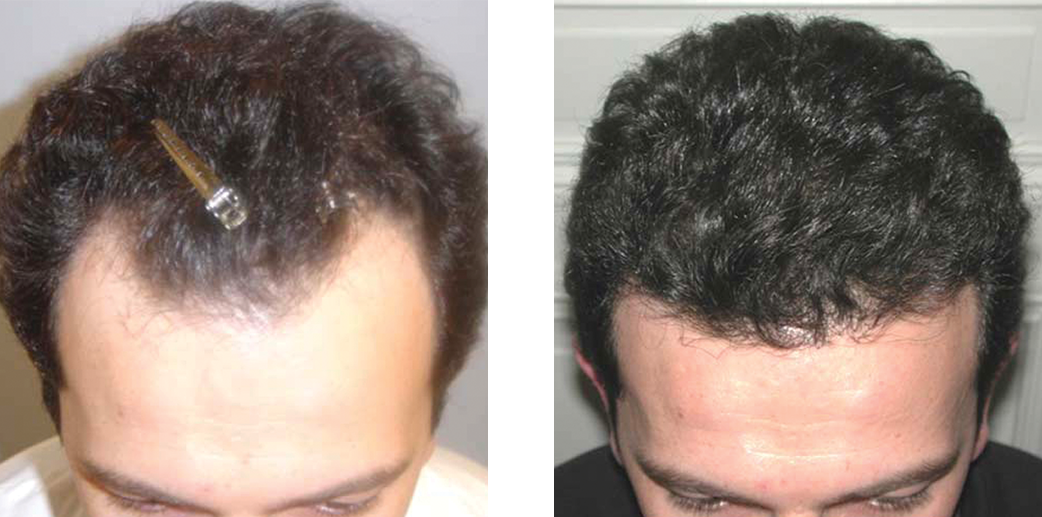 Before and after hair restoration image