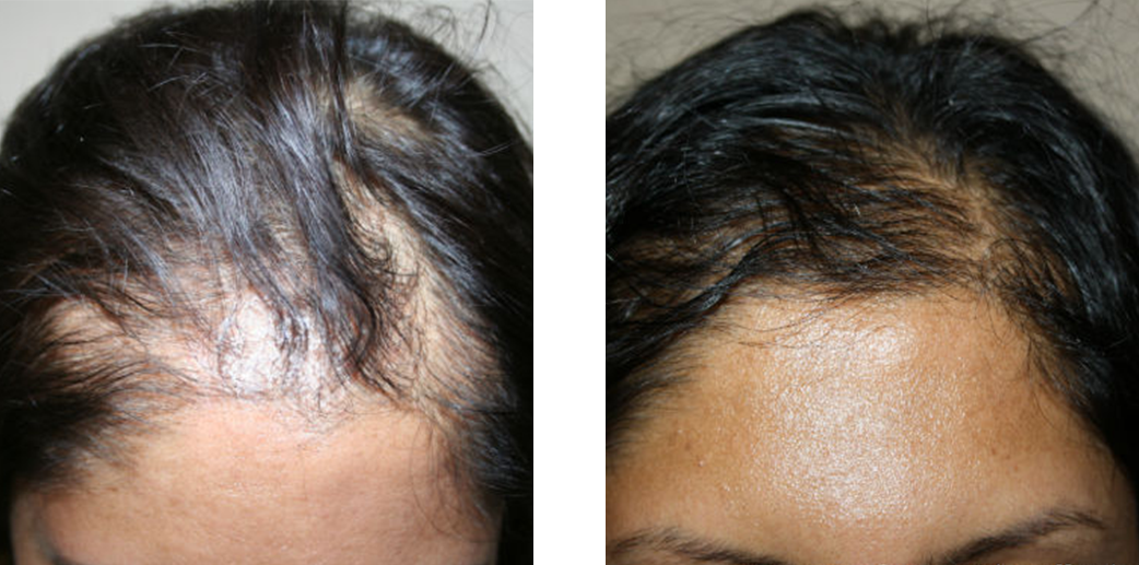 Hair transplant before and after results for a woman