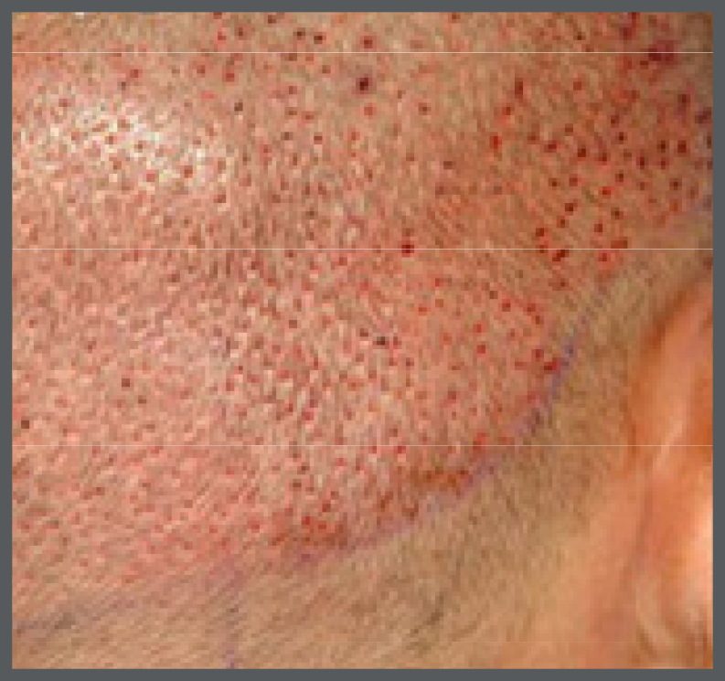 Back of head image after hair transplant