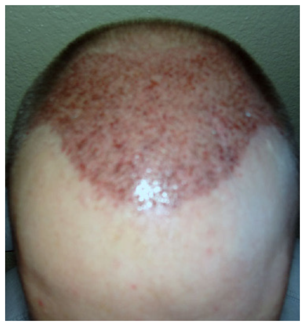 Patient 2- Post Op Hair restore image