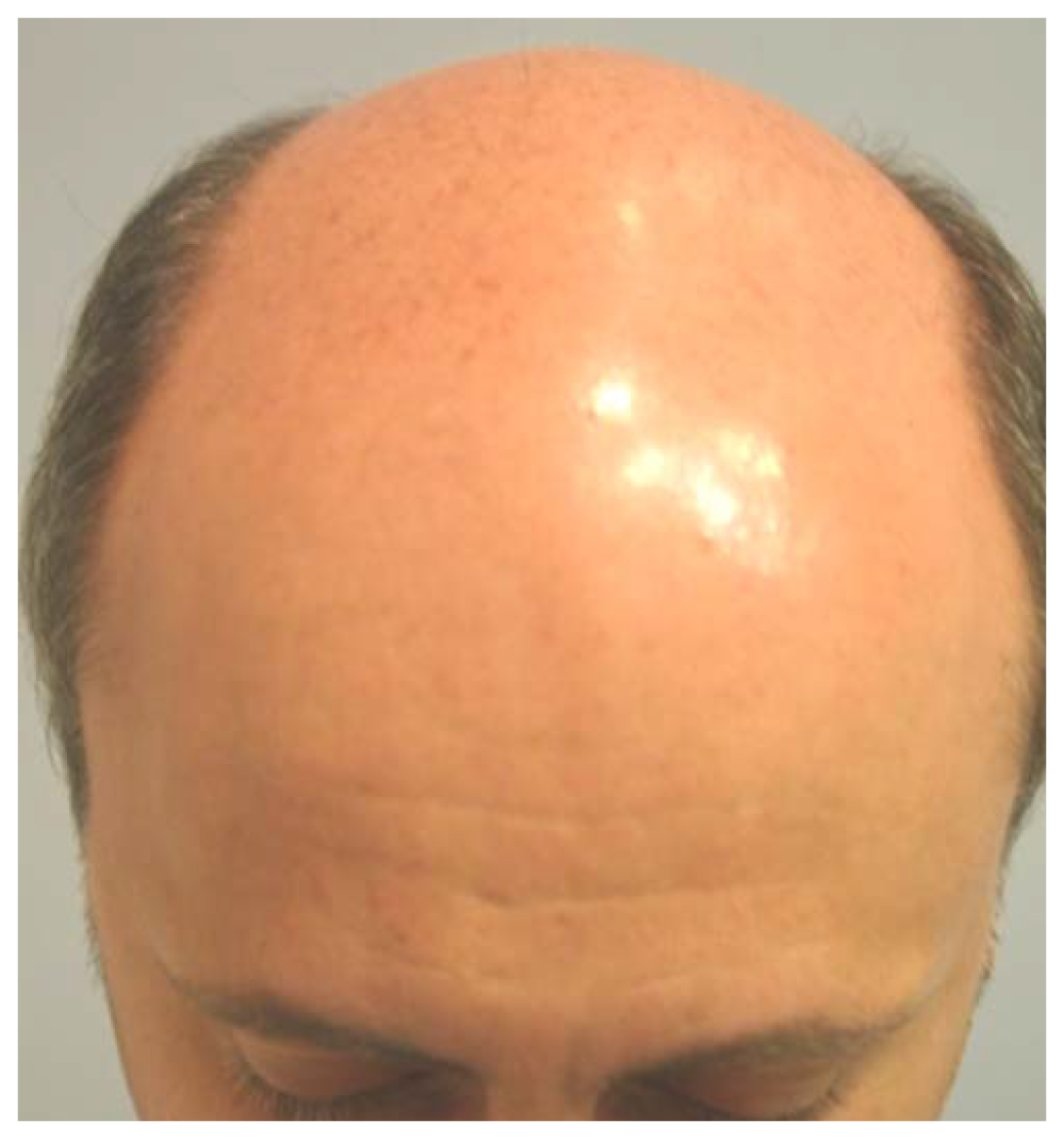 Patient 1-Before Picture of man with bald head