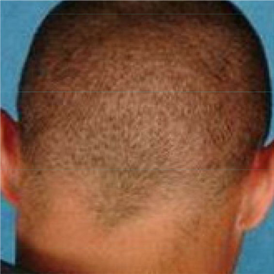 Image showing no scar technology on back of man's head