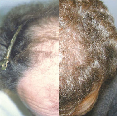 NeoGraft split picture of before and after results