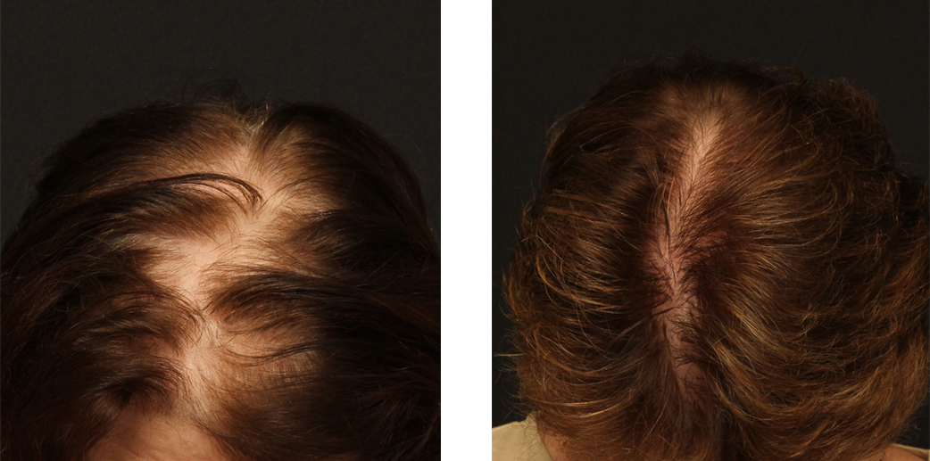 Hair transplant before and after results for a woman